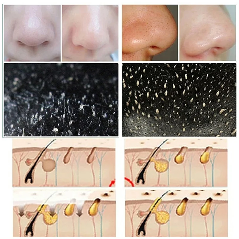 10pcs Blackhead Nose Strips De - Cleanser Face review and price